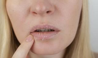 "جفاف الفم" علامة لـ5 أمراض خطيرة