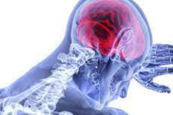 أبرز عوامل الإصابة بالسكتة الدماغية