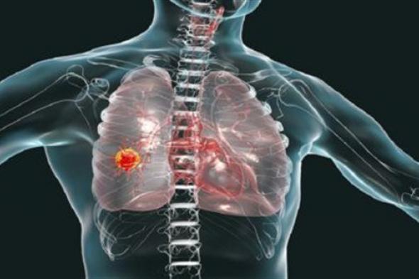 اختراق علمي يمكن أن يقلل من وفيات سرطان الرئة