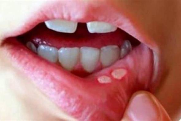 دراسة جديدة تقدم نظرة أعمق للعلاقة بين بكتيريا الفم الشائعة والأمراض المهددة للحياة.. التفاصيل الكاملة